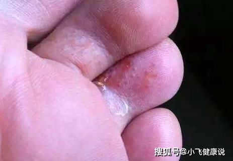 脚上红痒起皮,是脚气还是湿疹?一篇文章教你准确分辨 脚上红痒起皮,是脚气还是湿疹?一篇文章教你准确分辨