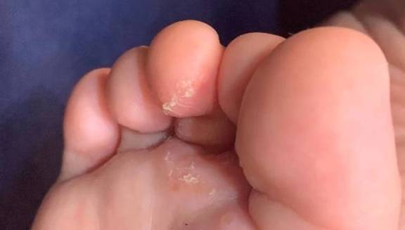 脚上红痒起皮,是脚气还是湿疹?一篇文章教你准确分辨 脚上红痒起皮,是脚气还是湿疹?一篇文章教你准确分辨